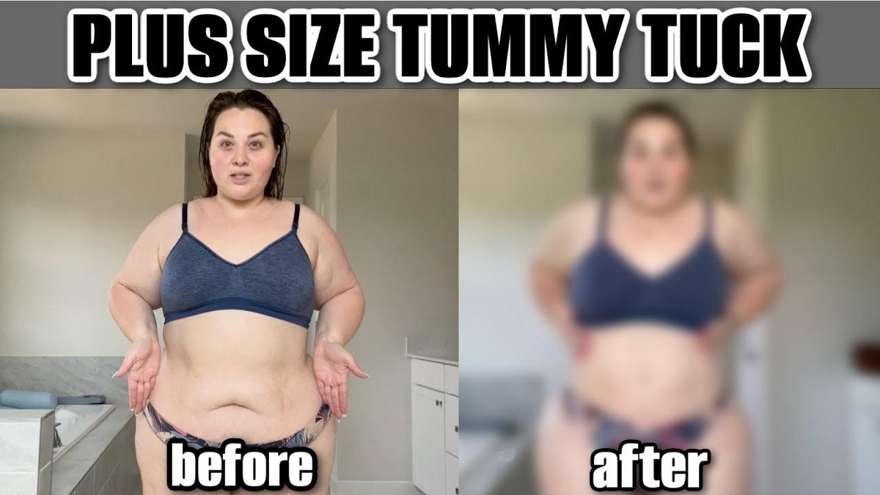 Before & After a Plus Size Tummy Tuck (Dr. Repta) 