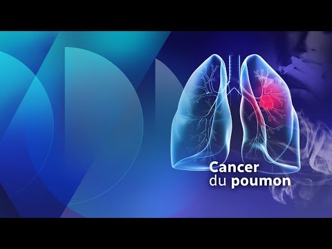 Le cancer du poumon chez les non-fumeurs