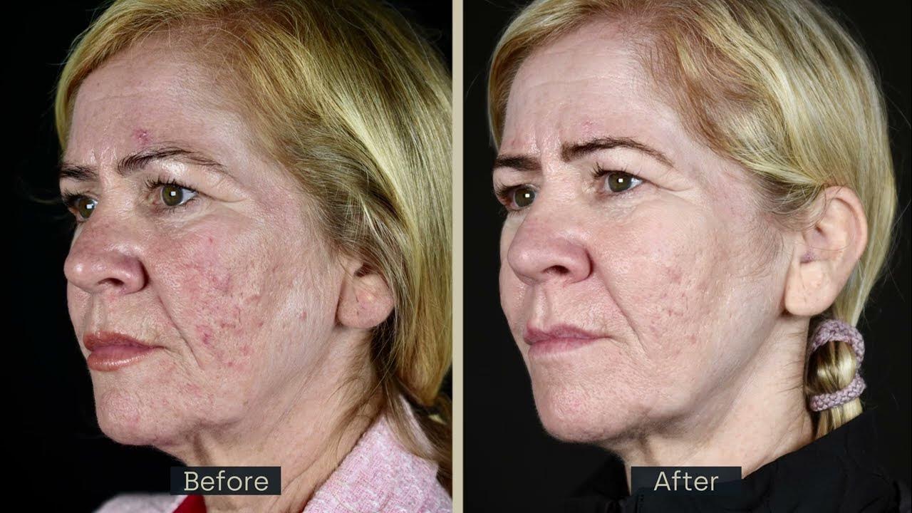 Punch Excision for Acne Scarring YouTube