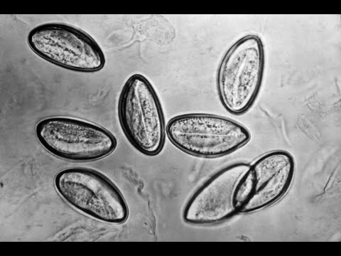 Enterobiasis (Pinworm infection)