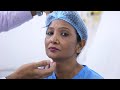 Revision Rhinoplasty | Nose Job | Correction Surgery | Dr. Sunil Richardson