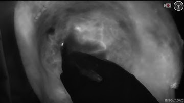 Using SPY-PHI to Visualize Perfusion to the NAC after NSM and Prepectoral Placement of Implant Sizer