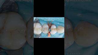 Class 2 restoration using Quad Matrix Sectional Matrix System