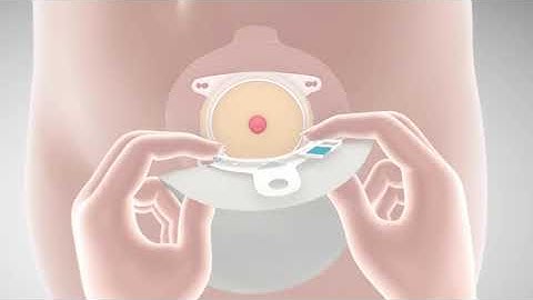 How to apply SenSura Mio with click application – instructional video, point of view of nurse