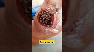 Medical Grade Maggots  Its A Thing