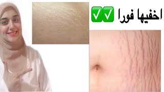 التخلص من الخطوط البيضاء والحمراء  وتشققات الجلد نهائيا stretch marks /نتيجة مضمونة 