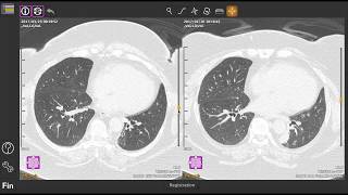 Registration lung CT