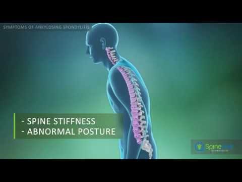 Ankylosing Spondylitis Symptoms