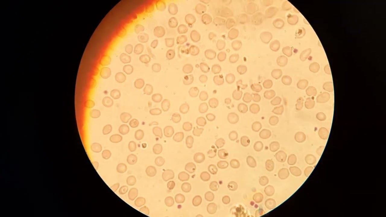 Blood film smear shows microcytosis, oval, target and teardrop red blood cells.