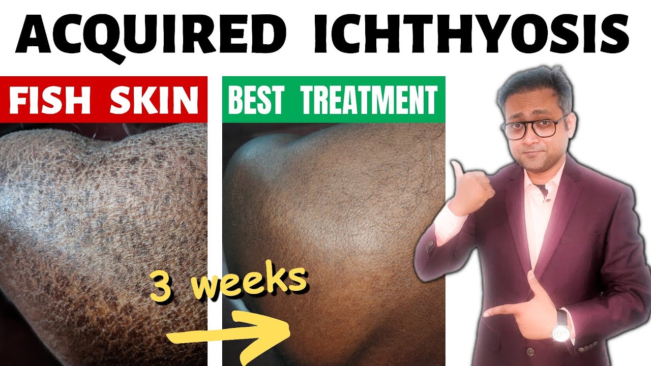 Acquired ichthyosis Fish skin Treatment Hindi YouTube