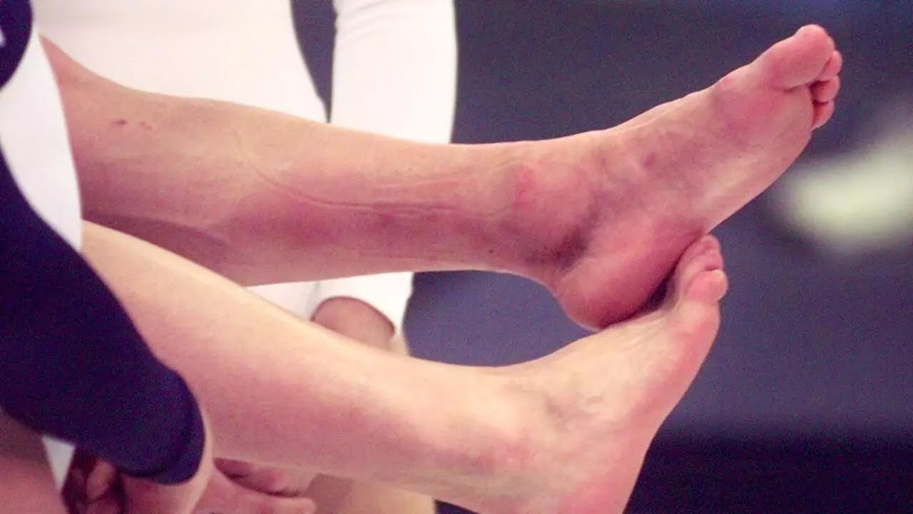 បាតជើង​សំប៉ែត​ មានផលវិបាក​និង​គ្រោះថ្នាក់​យ៉ាងណា?