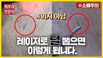 레이저 제모 1회차는 효과가 어느 정도 일까? 실제 영구제모 시술과정, 경과 공개!