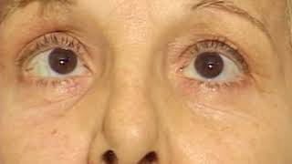 Parálisis Bilateral del VI Par Craneal (Harrison´s 18va Edición)