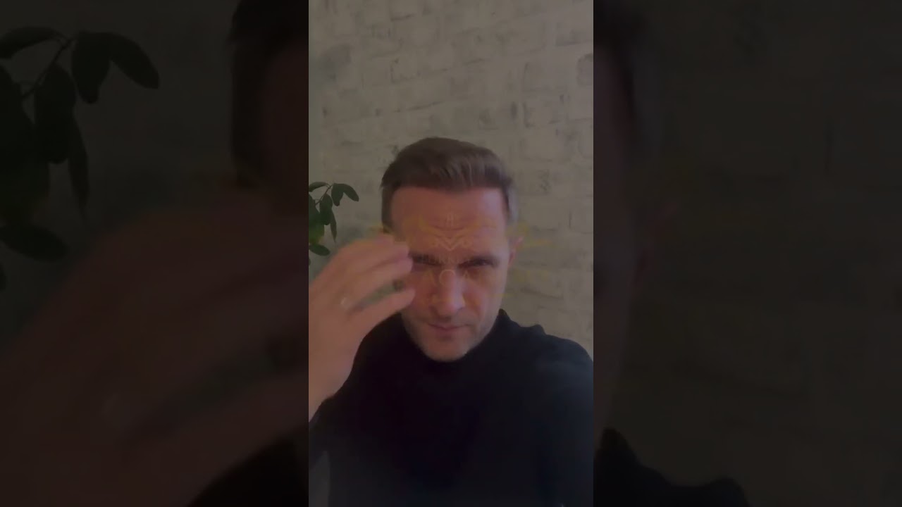 Hair transplant in Turkey Hair Academy İstanbul / Turkey ✅👌 Result: 11 months later