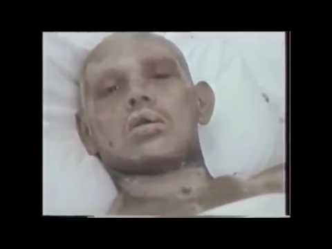 People affected by radiation during Chernobyl disaster. Radiation sickness. Part 1.