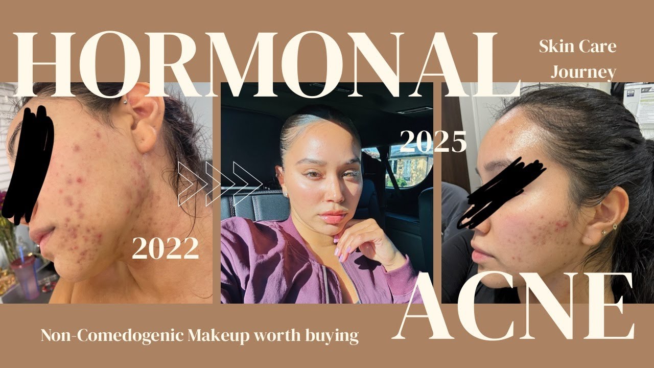 TREATING MY HORMONAL ACNE NATURALLY|1 WEEK UPDATE|MAKEUP PRODUCTS FOR ACNE PRONE SKIN ✨
