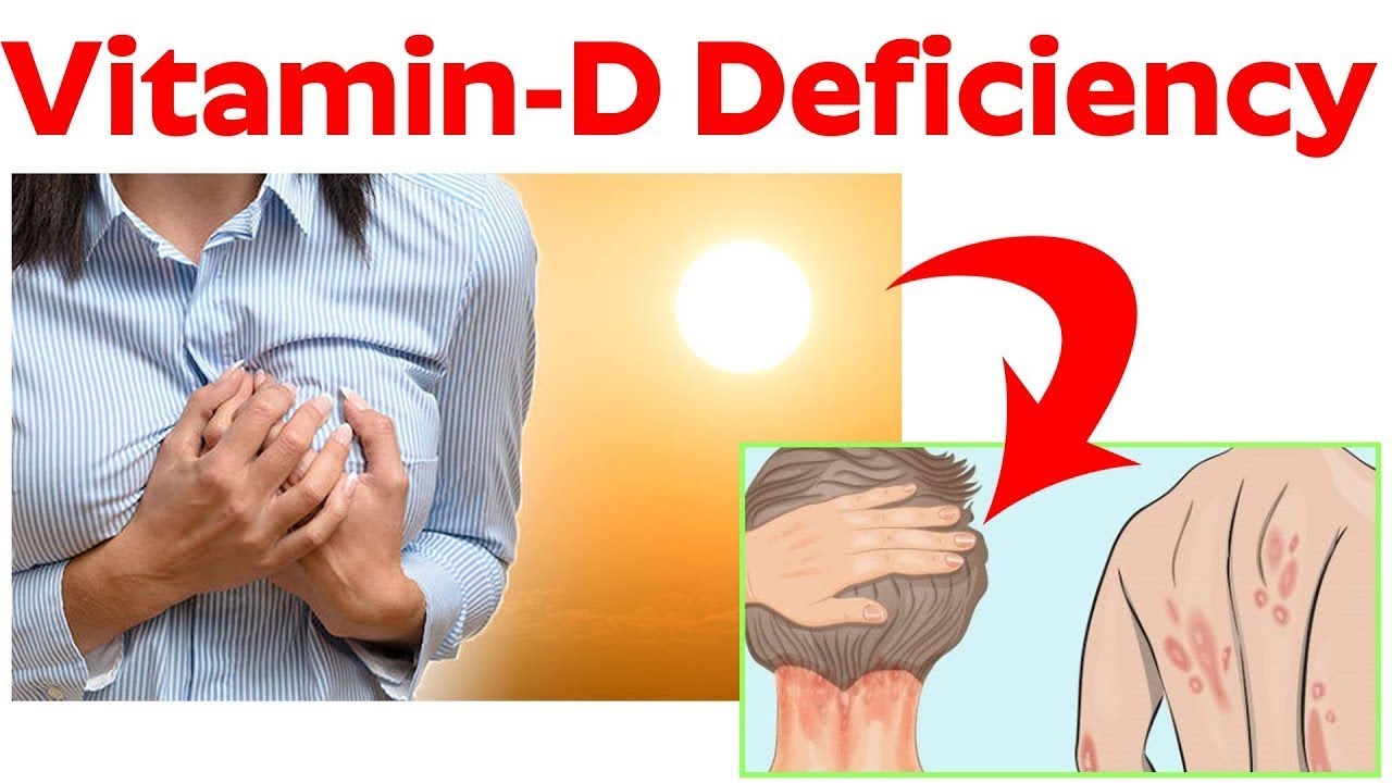ಹೀಗೆಲ್ಲಾ ಆಗುತ್ತಿದ್ದರೆ ವಿಟಮಿನ್ ಡಿ ಕೊರತೆಯ ಲಕ್ಷಣ..! Vitamin D deficiency