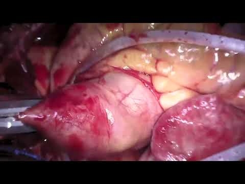 Repair Of A Sinus Venosus Defect Replacement Of An Unsuccessful MVR And Tricuspid Repair 