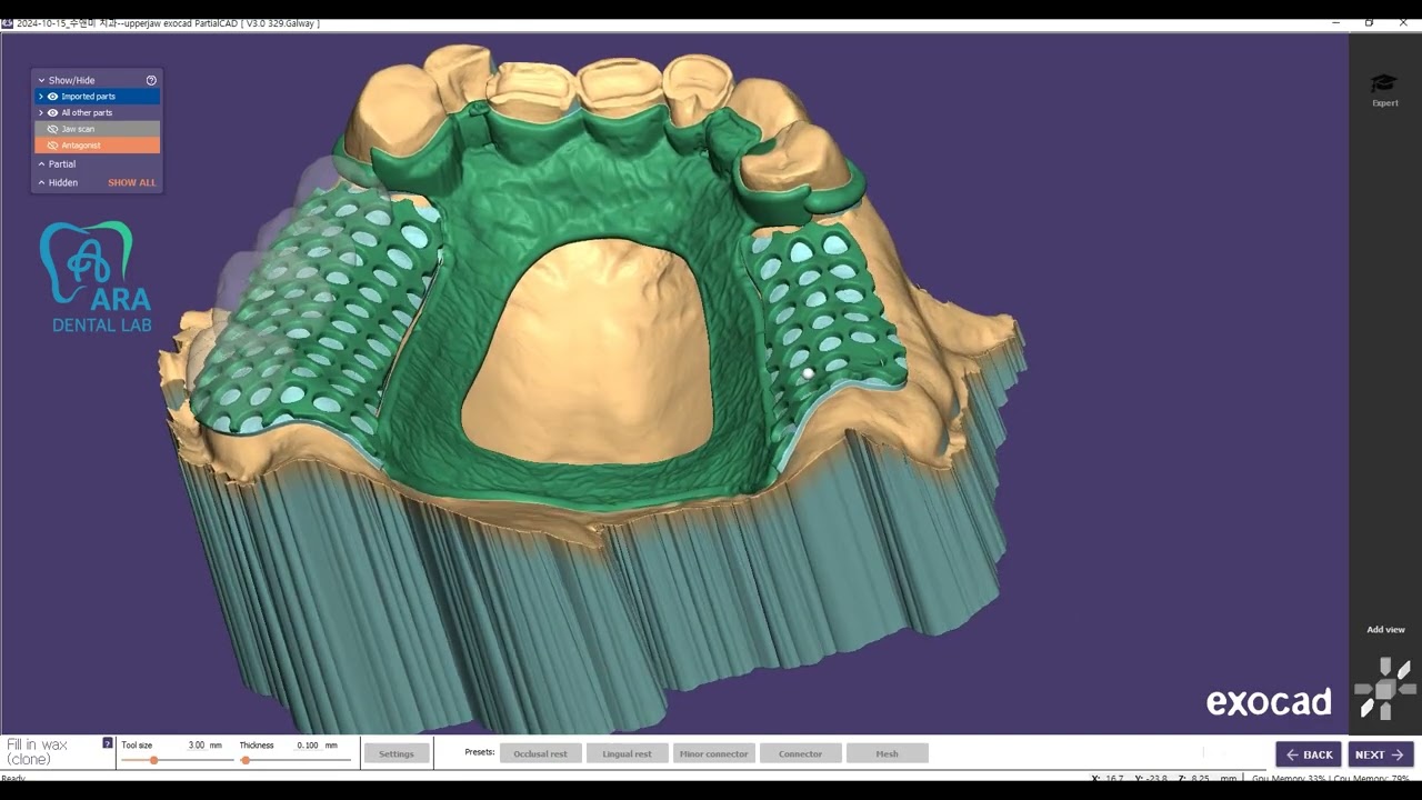 Upper partial frame  with Crown