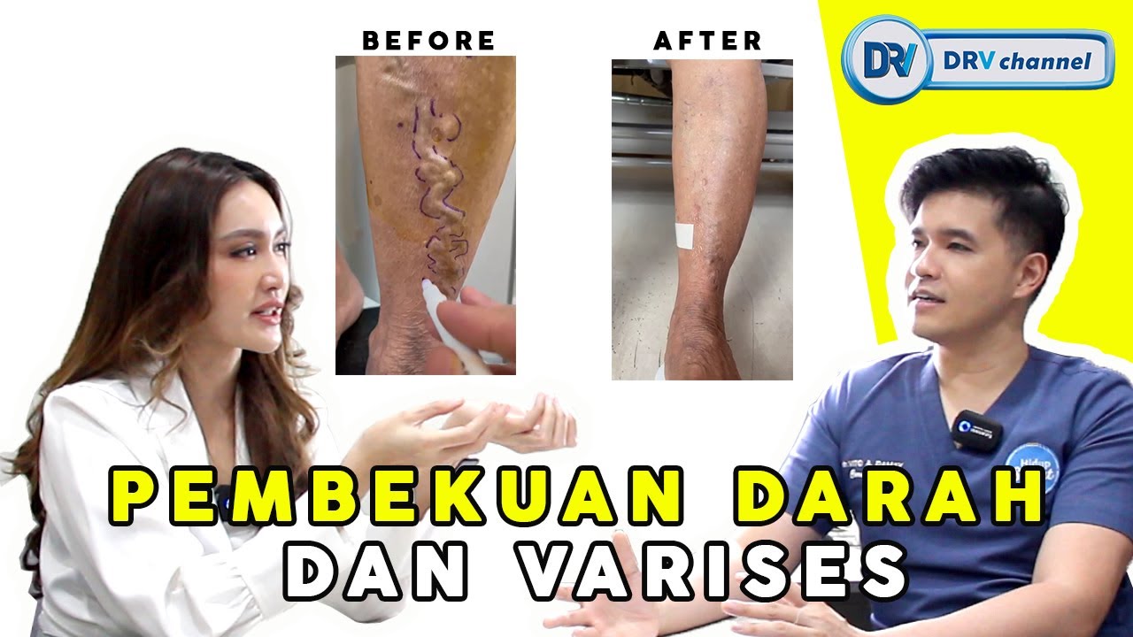 Dr Vito | Pembekuan Darah & Varises