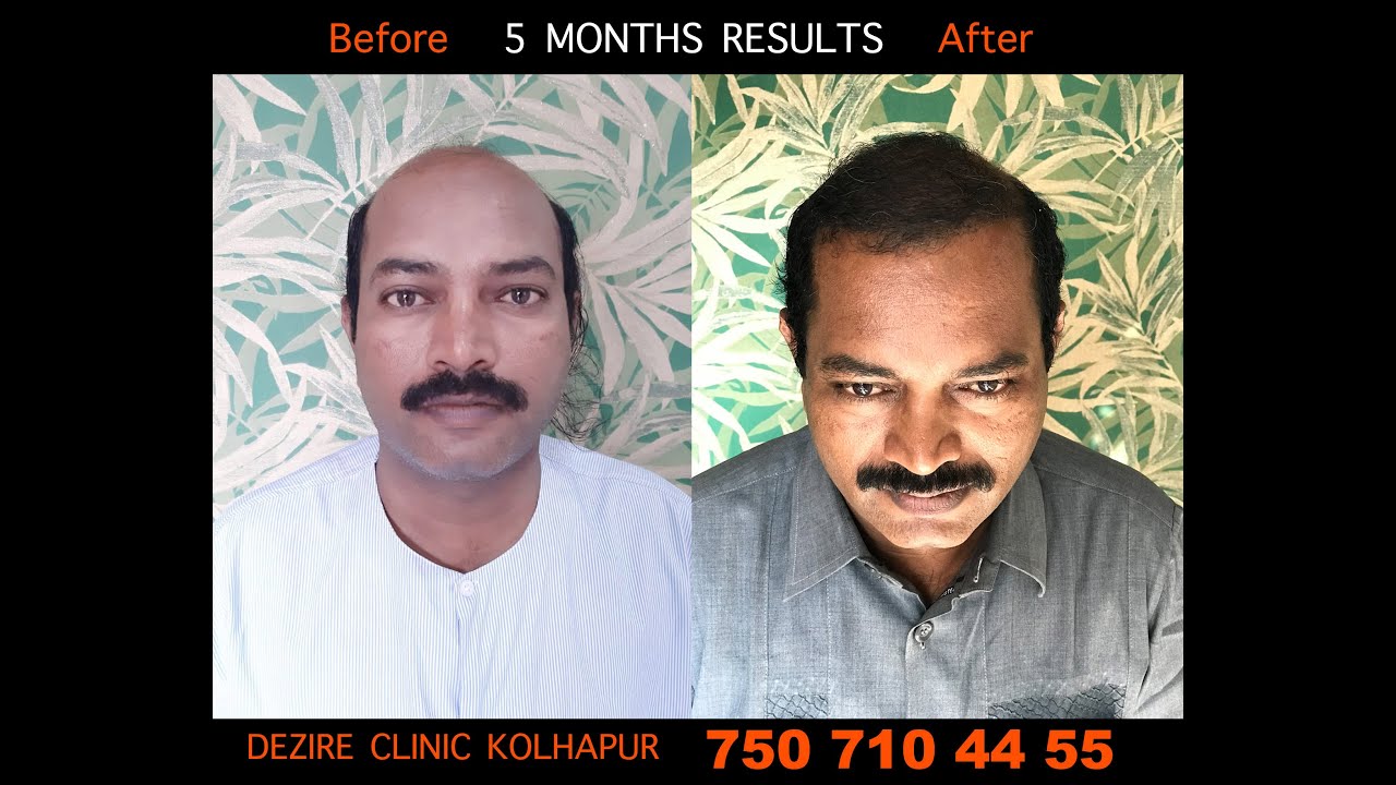 5 Month Results of Hair Transplant