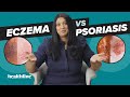 Understanding Eczema and Psoriasis
