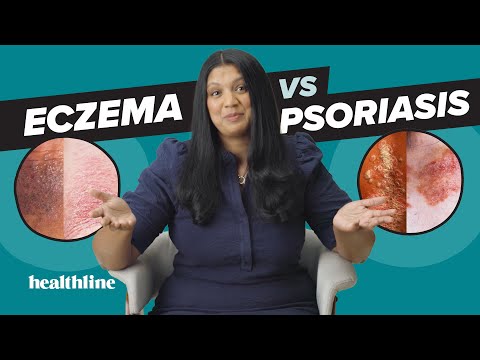Is Your Skin Issue PSORIASIS or ECZEMA?