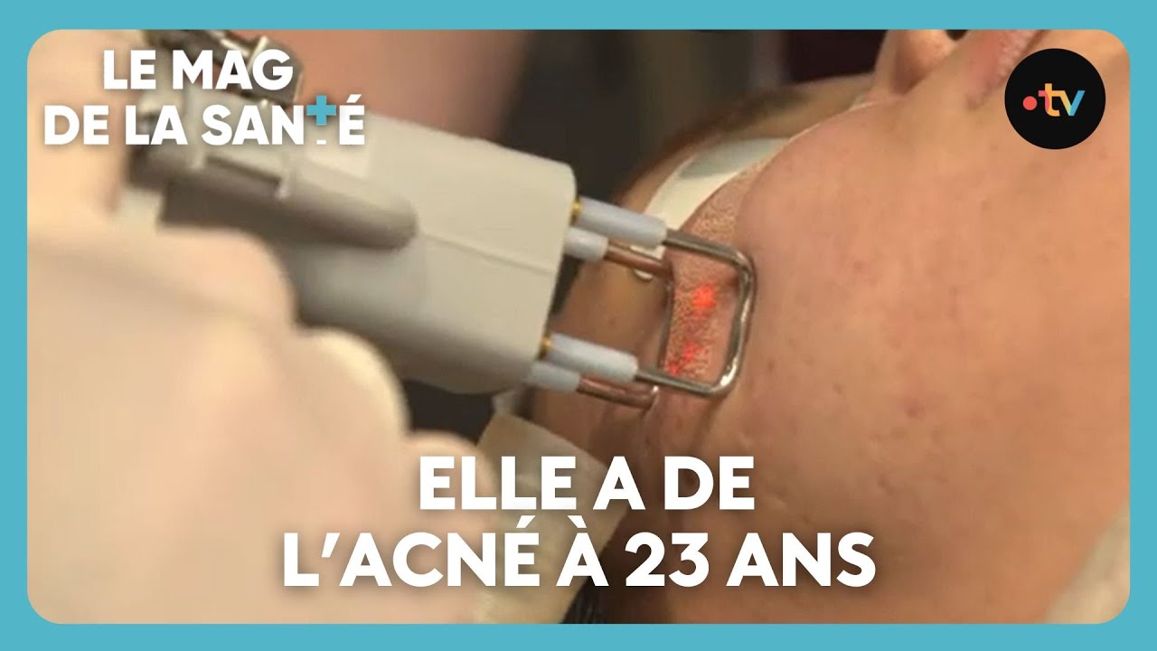 De l'acné à l'âge adulte ?