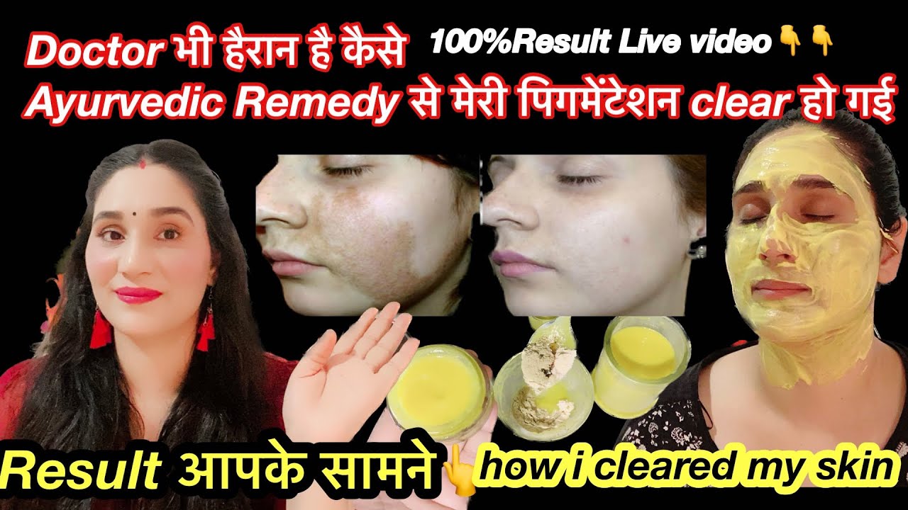 चेहरे के काले दाग-धब्बे ,पुरानी झाइयां,Melasma,hyperpigmentation दूर करने की सबसे तेज Cream |Melamet