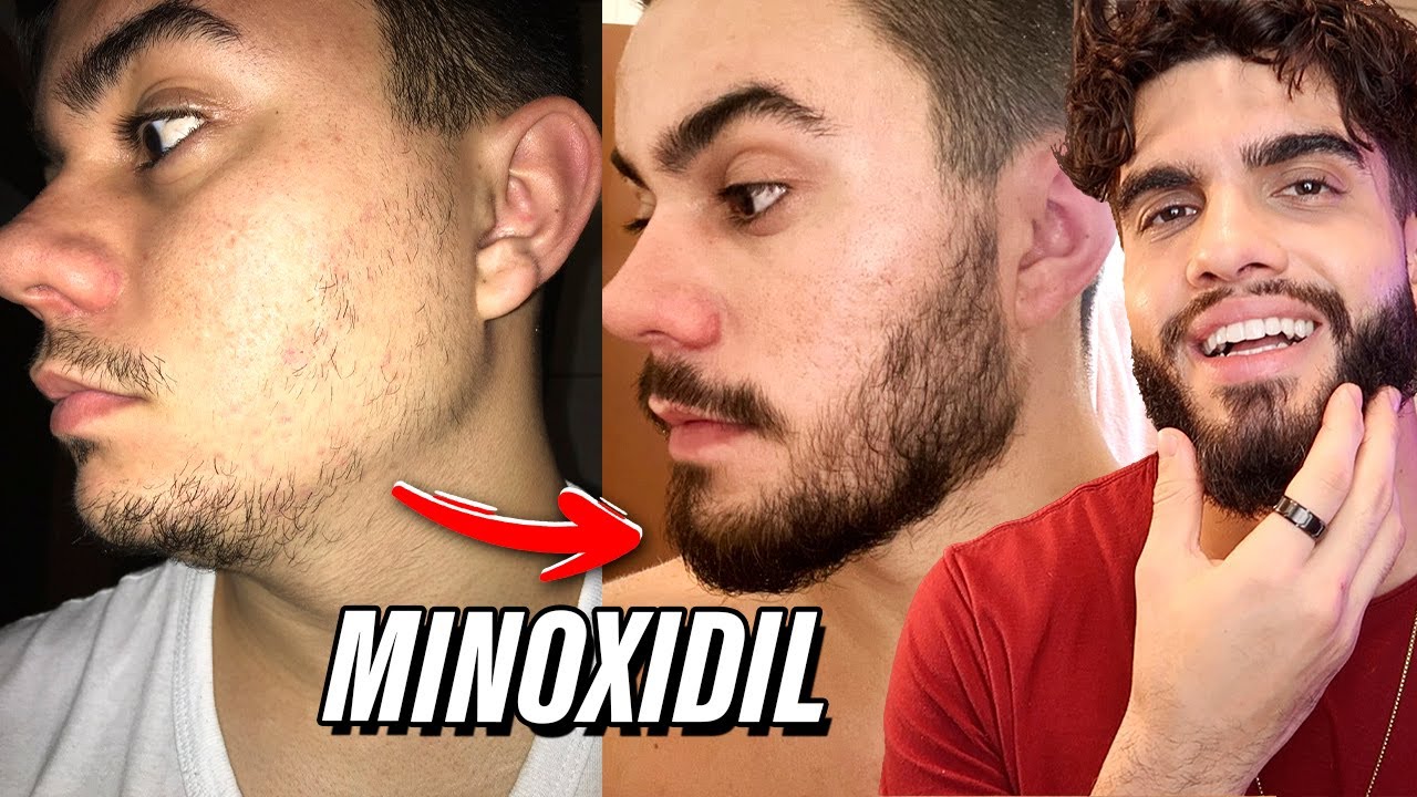 Evoluçao de Barba dos INSCRITOS com MINOXIDIL antes e depois - YouTube