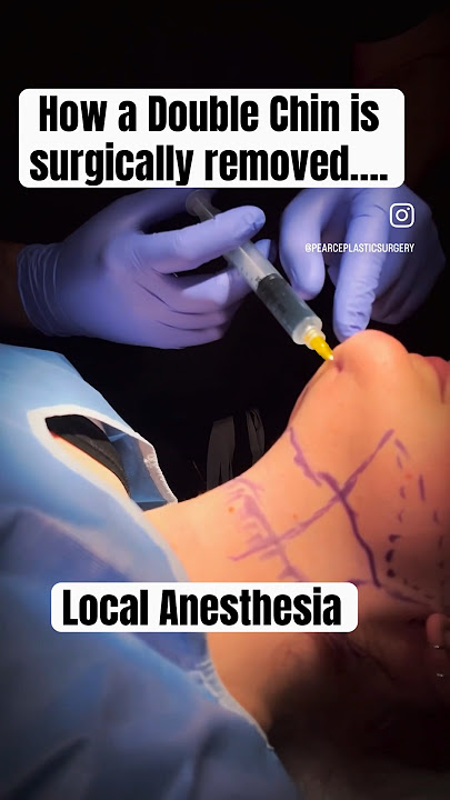 How to get rid of a double chin|| Austin Chin Lipo