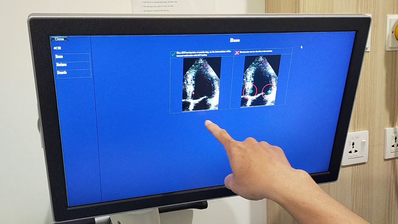 SIÊU ÂM "AFI" TRÊN VIVID S70N- GE