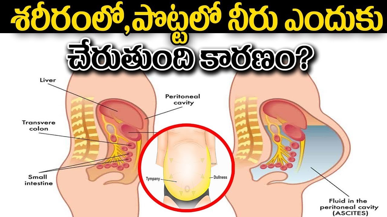 శరీరంలో,పొట్టలో నీరు చేరడం...ఎందుకు?కారణం? | 10 Foods That Help Flush Water Retention