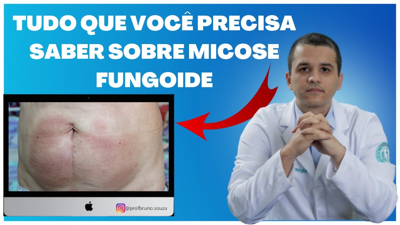 Micose fungoide: o que é, sintomas, causas e tratamento - Tua Saúde