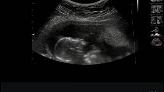 Minha Filha Mandando Beijo Na Ultrom