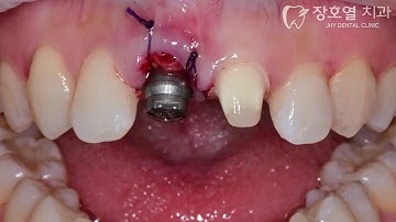 #11 Immediate implant placement & loading with fully digital workflow