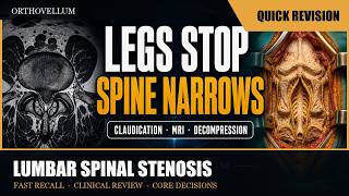 Lumbar Spinal Stenosis — Claudication, Imaging, Decompression — Quick Revision (clinical review)