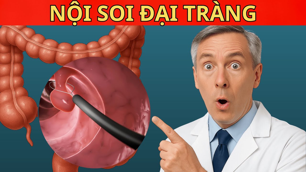 10 câu hỏi thường gặp về Polyp đại tràng và Nội soi đại tràng