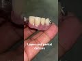 Upper cast partial denture 😬😬😬#apexdental #splittooth #dentistry #partialdenture #orthodontist