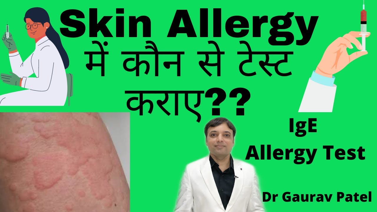 Test in skin allergy in Hindi | स्किन ऐलर्जी में कौन से रिपोर्ट कराए? S.IgE & Allergy test