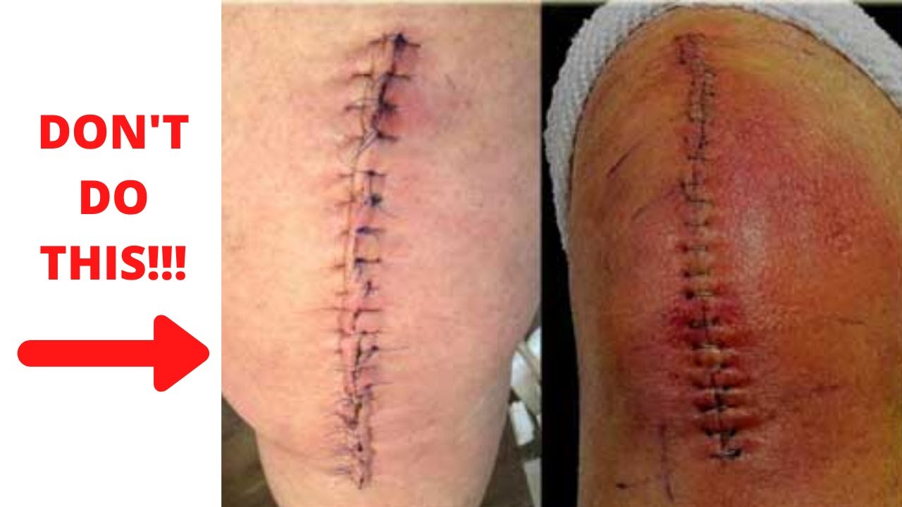 Bow Legs No More Review [2020] (COMPLETE) -  How To Fix Bow Legs Without Surgery