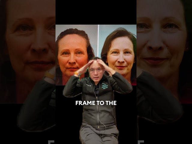 The Importance of Female Hairline Restoration in Overall Female Facial Rejuvenation