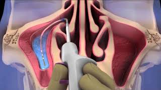 Acclarent Balloon Sinusplasty - Andros ENT & Sleep Center Acclarent Spinplus