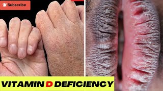 10 Signs Your Body Is Begging for Vitamin D | Vitamin D Deficiency | Vitamin D Symptoms