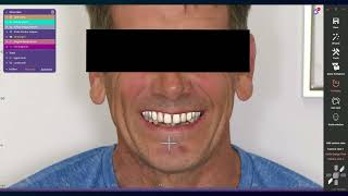 Full-Arch Digital Smile Design to Implant Prosthesis in exocad | Complete Workflow