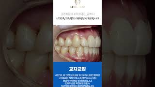 교차교합, 비발치교정, 확장배열 #양산교정치과 #양산치아교정