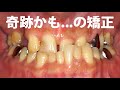 日本の奇跡と呼ばれた症例・死にたいほど歯の悪い人の歯列矯正 GVBDO  Before & After Braces -Time Lapse -269 Days - +all dental care