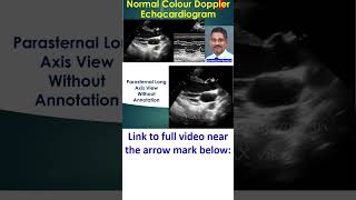 Normal Color Doppler Echocardiogram