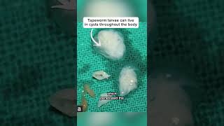 Deliberate Parasite Infection