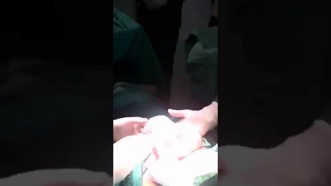 mucize bebek anne karnında keseyle dogdu YouTube